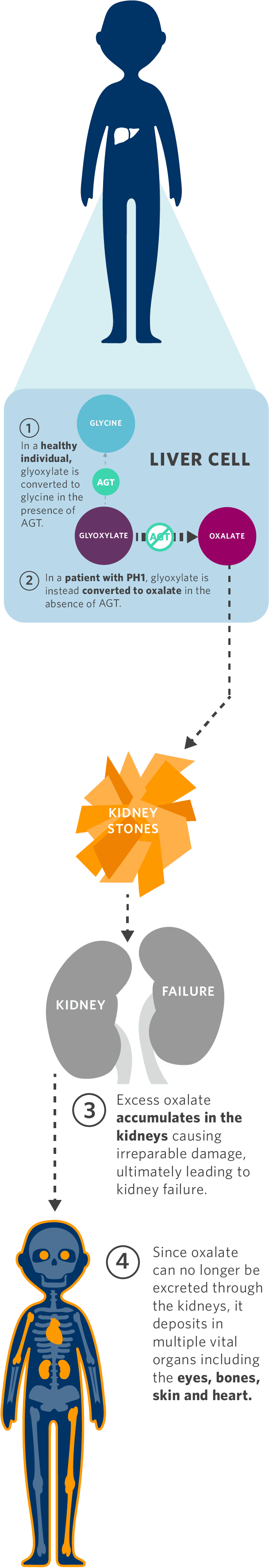 Understanding Primary Hyperoxaluria—symptoms And Causes Alnylam®